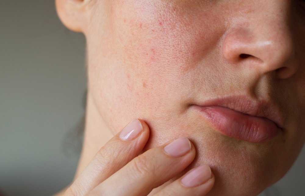 Woman with Dry Skin and Large Pores — Bespoke in Southport, QLD