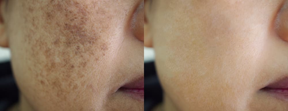 Woman Showing Face Before And After Melasma Treatment, Highlighting Improvement — Bespoke in Southport, QLD