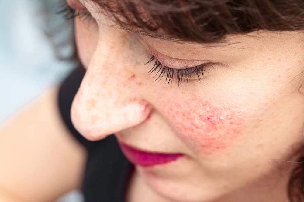 Woman With Red Facial Spots Indicating Rosacea — Bespoke in Southport, QLD