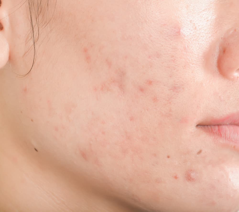 Woman With Acne And Visible Scars On Her Face — Bespoke in Southport, QLD