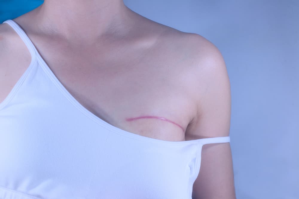 Woman With Large Chest Scar From Recent Surgery — Bespoke in Southport, QLD