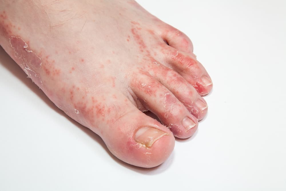 Foot With Rash And Dry Skin Clearly Highlighting Affected Area — Bespoke in Southport, QLD