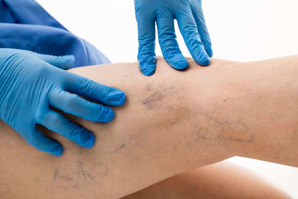 Individual Wearing Blue Gloves Showing Spider Veins On Legs — Bespoke in Southport, QLD