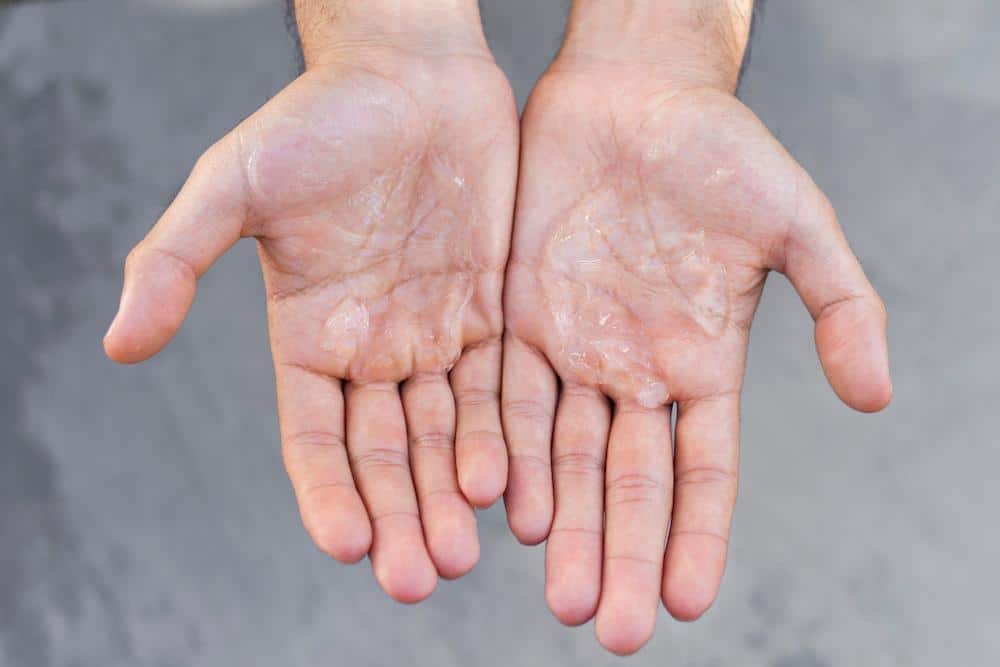 Man’s Hands With White Spots Indicating Hyperhidrosis — Bespoke in Southport, QLD