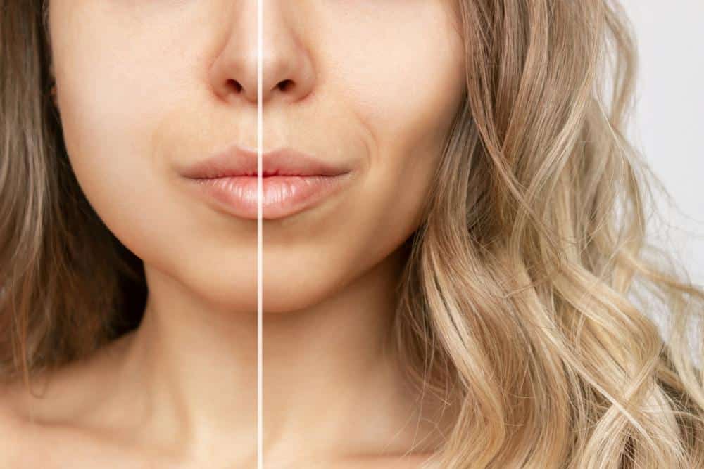 Before and After Images Highlighting Improvements in a Woman's Volume Loss and Hollow Cheeks — Bespoke in Southport, QLD